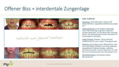 mykie fallbeispiel offener biss und interdentale zungenlage