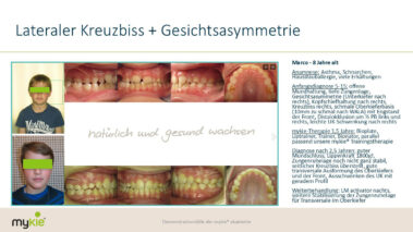 mykie fallbeispiel kreuzbiss gesichtsasymmetrie