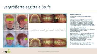 mykie® - Fallbeispiel Sagittale Stufe vergrößert